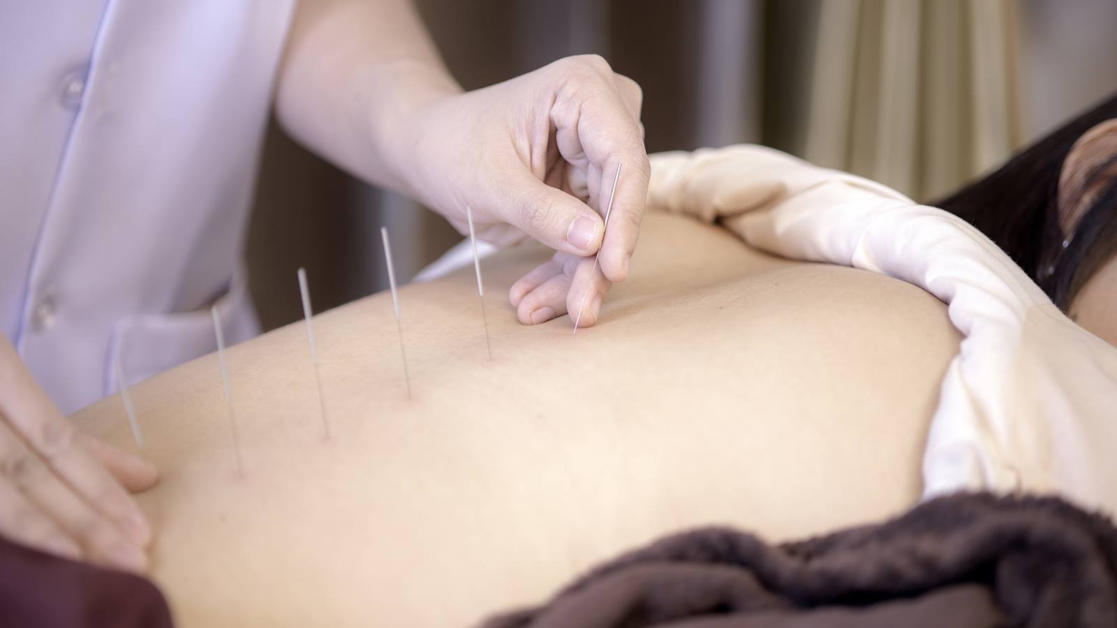 Acupuncture services Melbourne