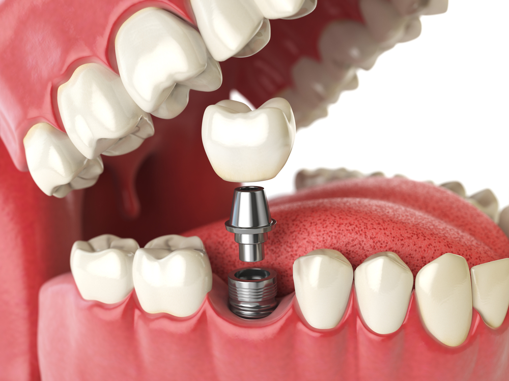 dental implants Christchurch